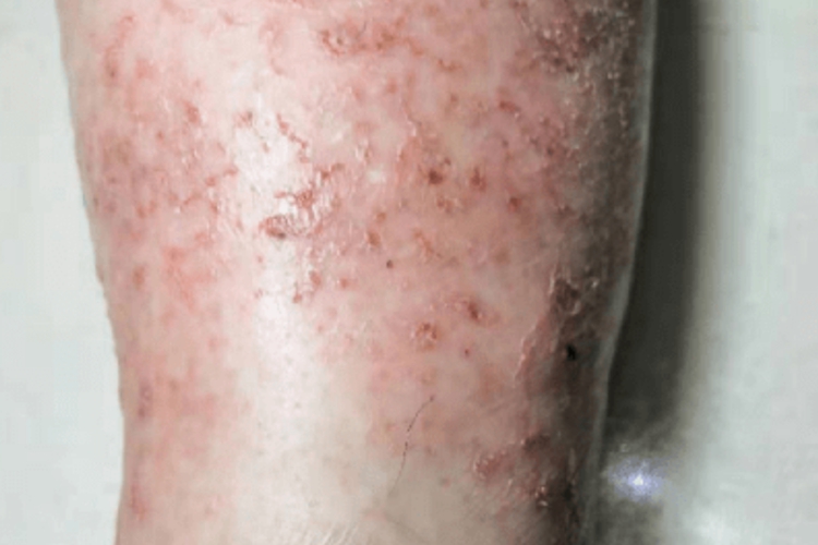 老人急性湿疹图