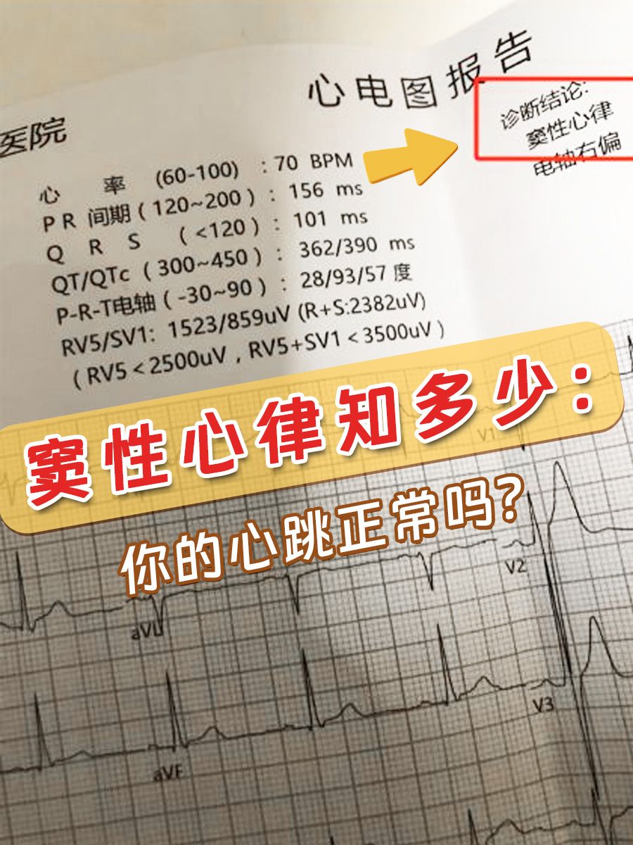 窦性心律知多少：你的心跳正常吗？