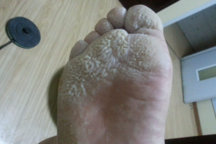 沟状跖部角质松解症脚掌很多坑图