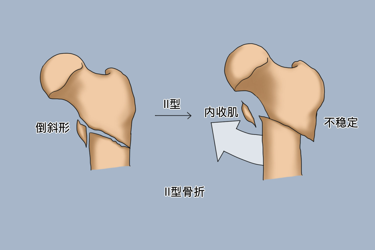 EvansⅡ型逆转子间骨折图