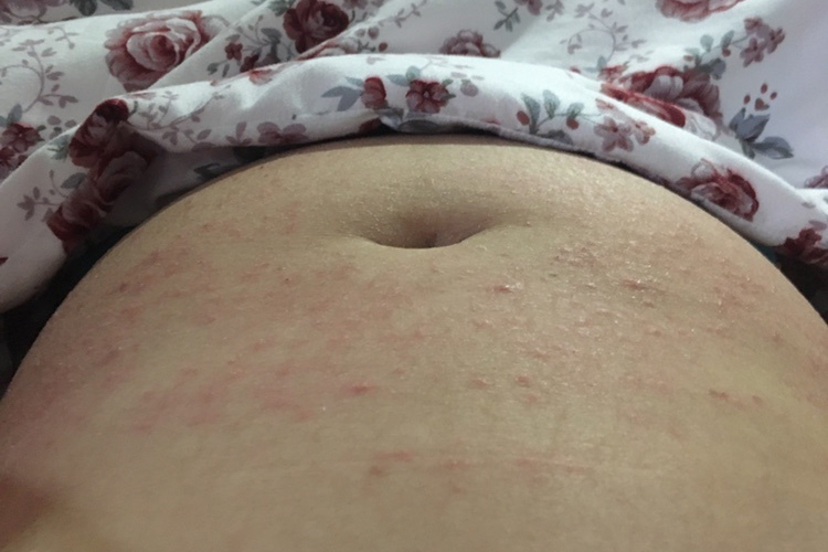 孕妇红色湿疹图