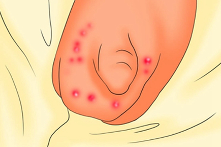 梅毒疹阴囊红色丘疹图 梅毒疹阴囊红色丘疹图