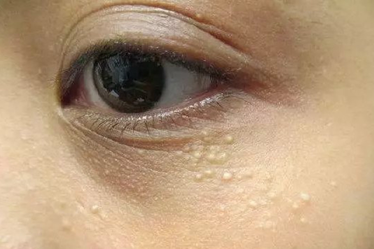 汗腺瘤眼睑白点图