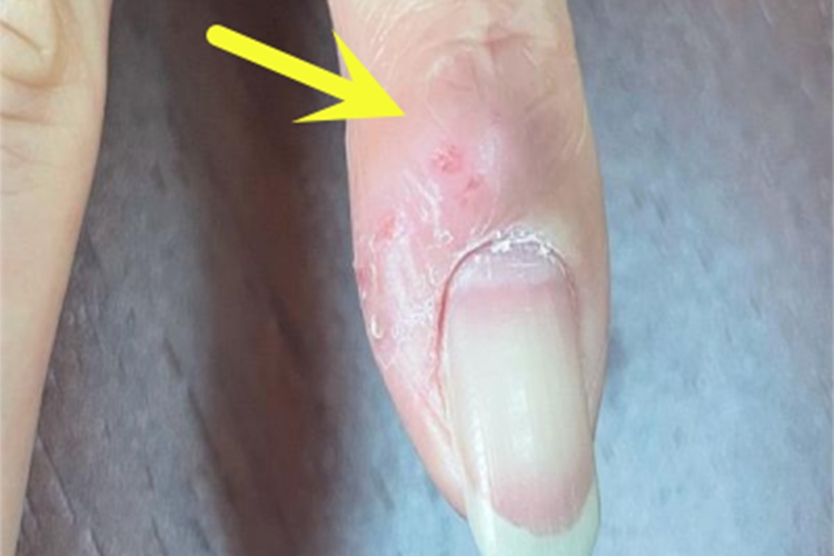 海鱼分枝杆菌感染手指硬包图