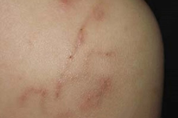 颚口线虫病背部症状图