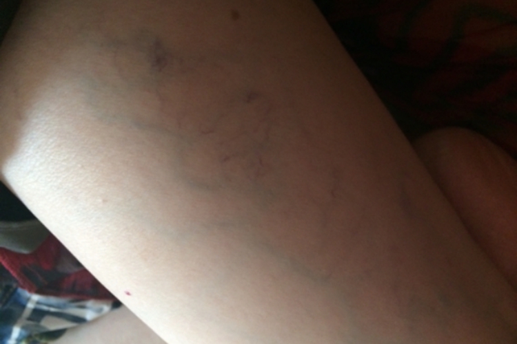 大腿内侧正常静脉血管图