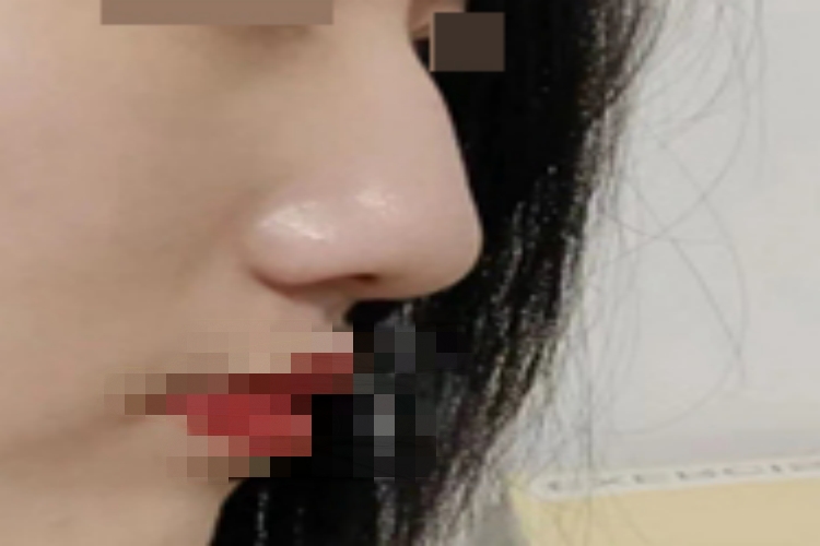 驼峰鼻鼻梁部位比较宽图