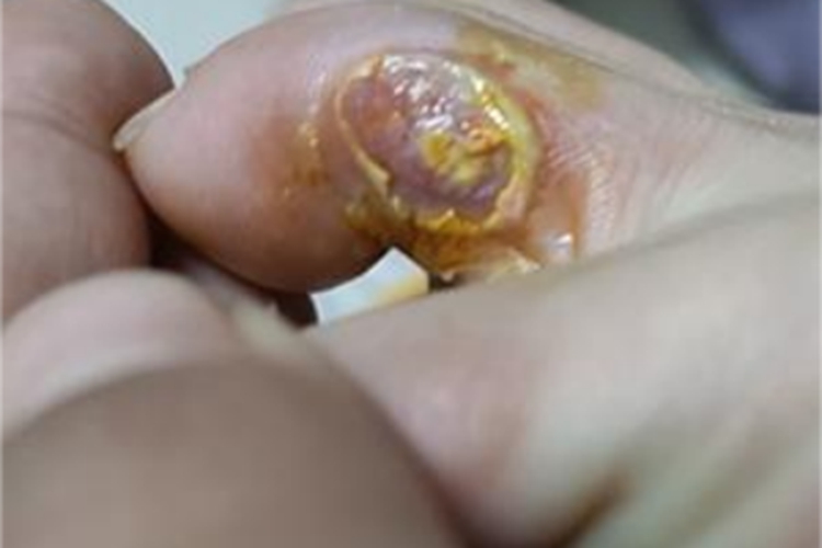 尖锐湿疣脚趾糜烂图 尖锐湿疣脚趾糜烂图