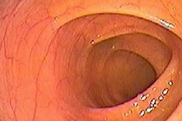 正常肠镜血管纹理清晰图