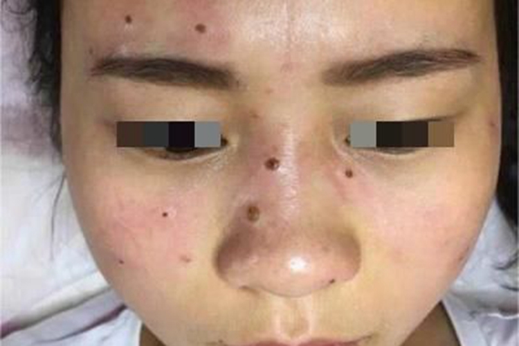 皮内痣面部小疙瘩图