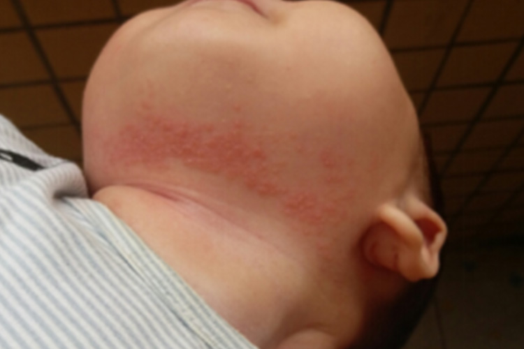 小孩颈部湿疹图 小孩颈部湿疹图