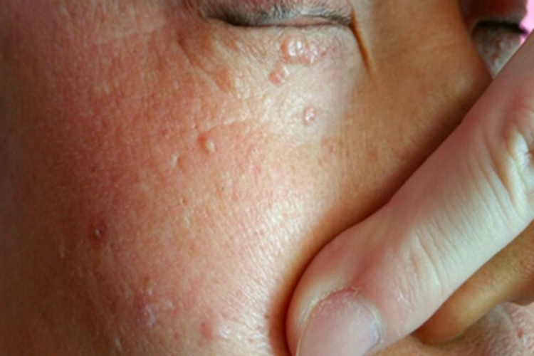 汗腺瘤眼周红色扁平疙瘩图