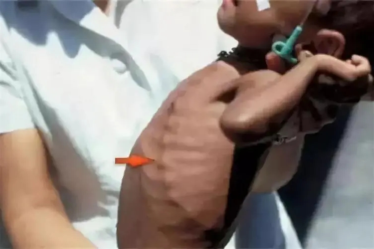 宝宝缺钙肋骨串珠图