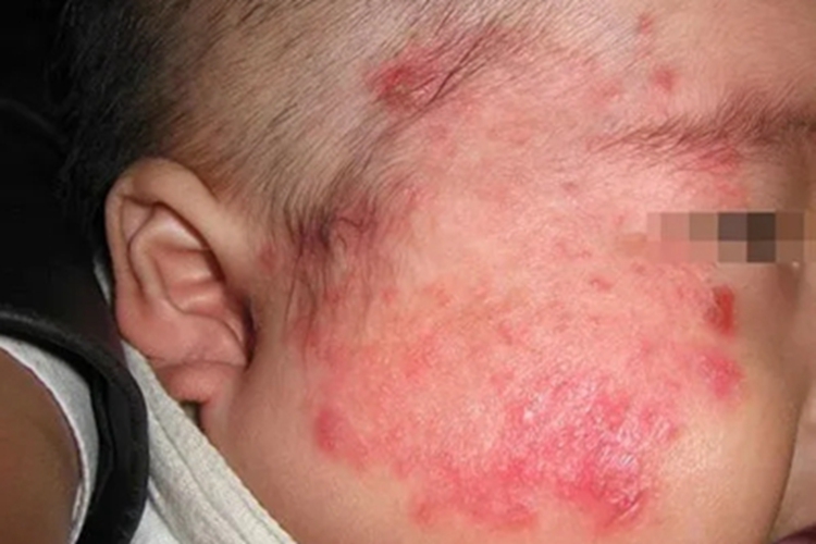 体癣面部红斑图