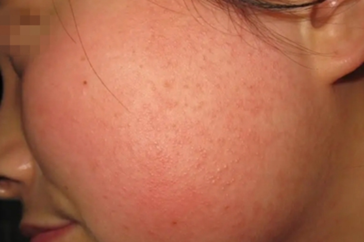 面颈部毛囊性红斑黑变病症状图 面颈部毛囊性红斑黑变病症状图