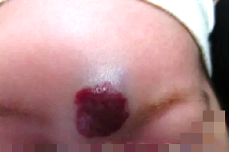 小孩额头血管瘤图