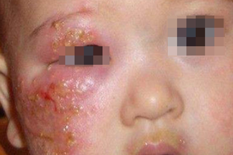 眼眶蜂窝织炎眼周症状图