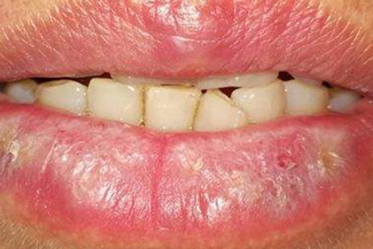 扁平苔藓嘴唇白斑脱皮图 扁平苔藓嘴唇白斑脱皮图