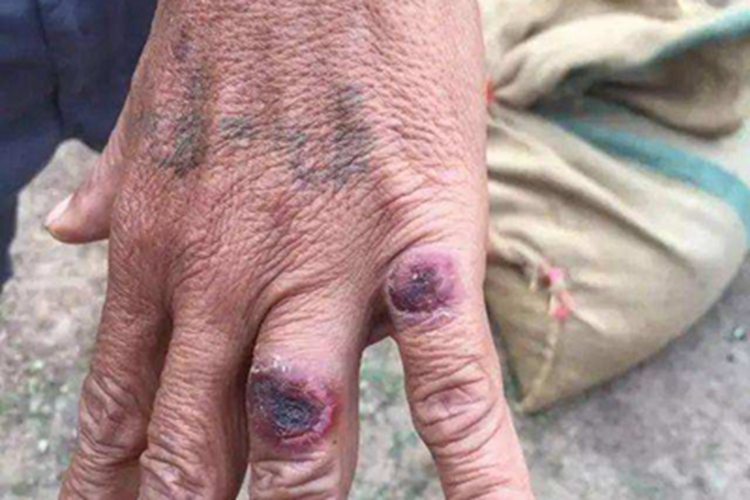 炭疽病手部症状图 炭疽病手部症状图