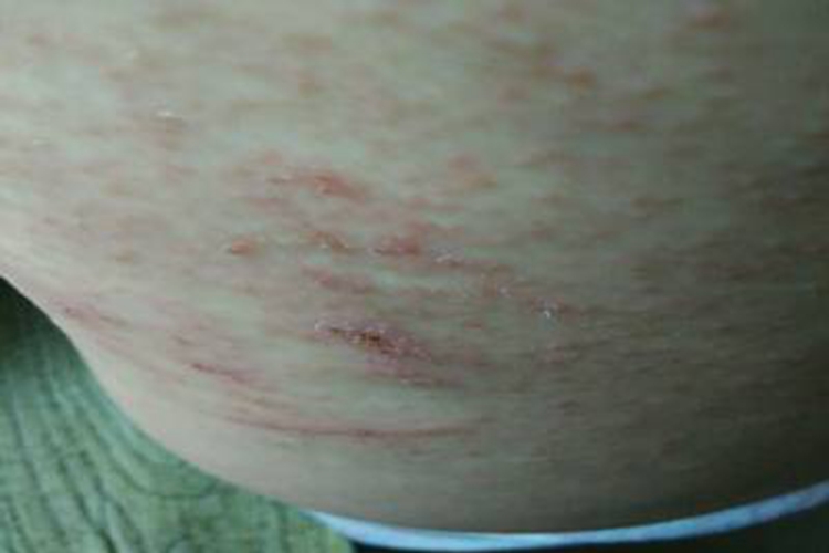 急性湿疹腰部症状图 急性湿疹腰部症状图