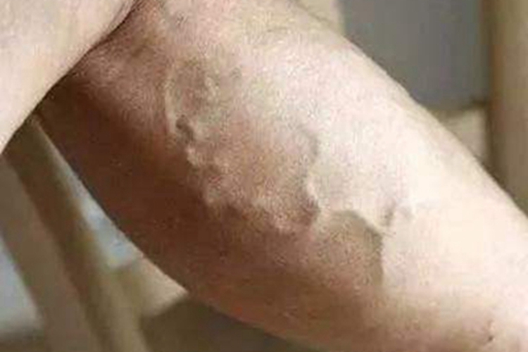 皮肤蝇蛆病小腿条纹图 皮肤蝇蛆病小腿条纹图