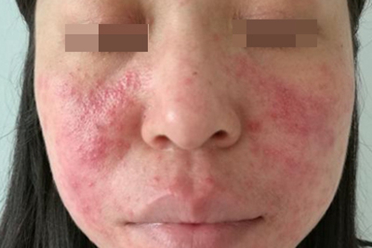 糖皮质激素依赖性皮炎红肿图