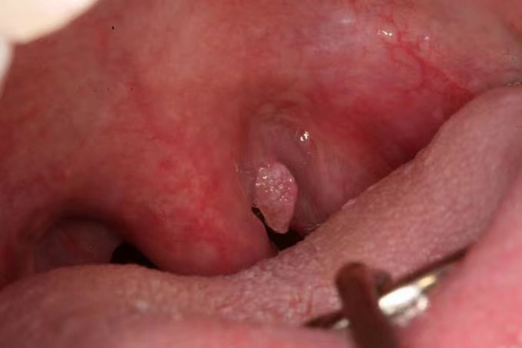 悬雍垂旁边乳头状瘤图