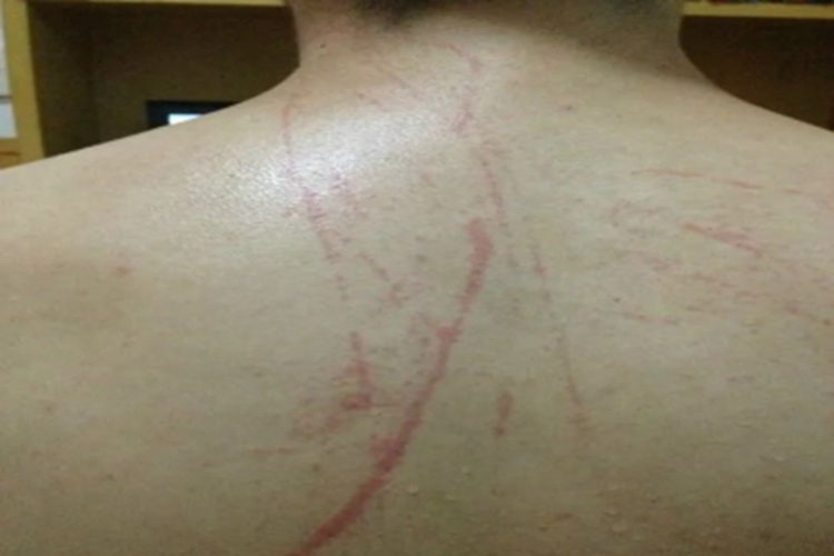 海蜇蜇伤背部红斑图