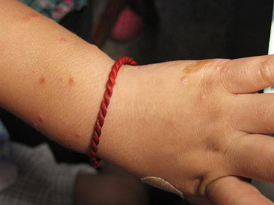 小儿丘疹性肢端皮炎症状图片