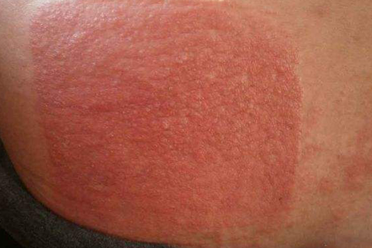 背部接触性皮炎图 背部接触性皮炎图