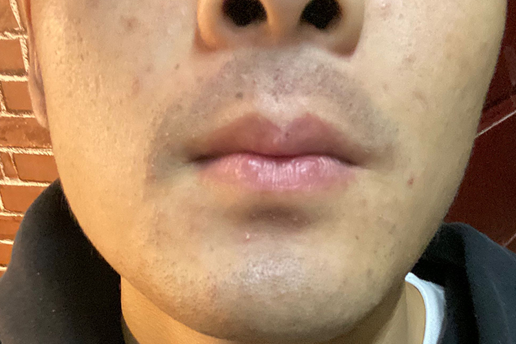 拔胡子黑色素沉淀图