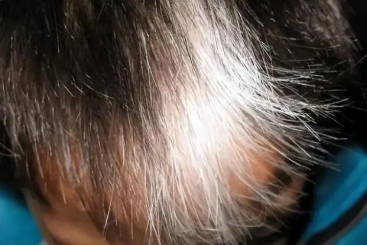 前额长白发图