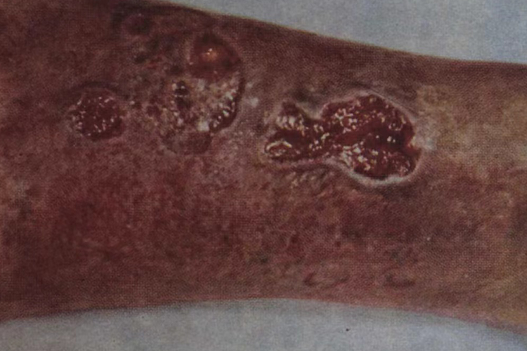 梅毒小腿梅毒性树胶肿图