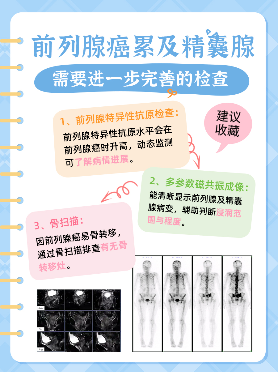 别忽视!前列腺癌累及精囊腺算转移吗?快瞧瞧