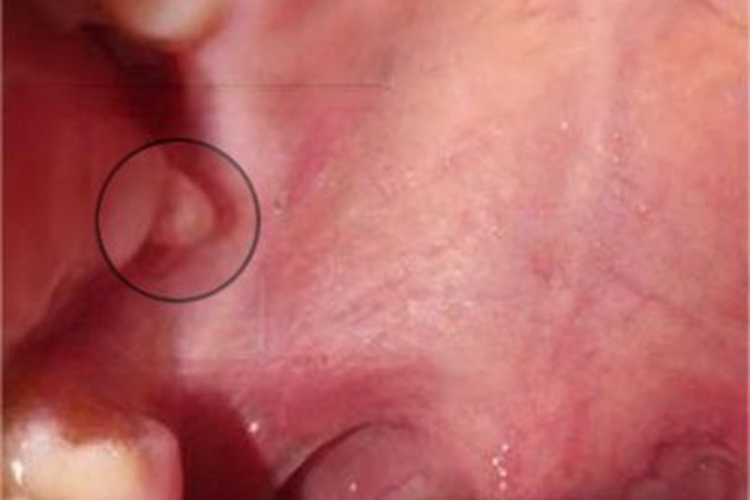 黏液腺囊肿口腔小疙瘩图