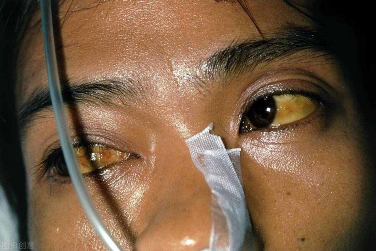 肝癌肿瘤晚期的人黄疸图 肝癌肿瘤晚期的人黄疸图