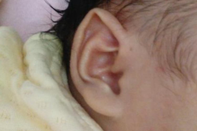 招风耳大耳廓往前倾图 招风耳大耳廓往前倾图