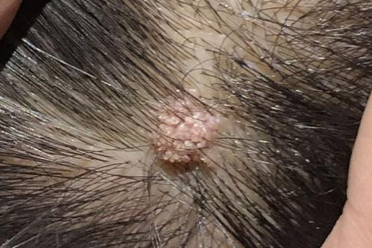 老年人头上长寻常疣图