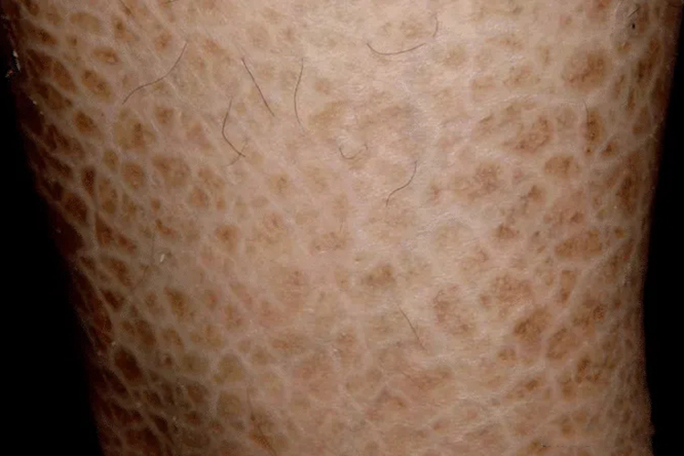 X连锁隐性鱼鳞病图