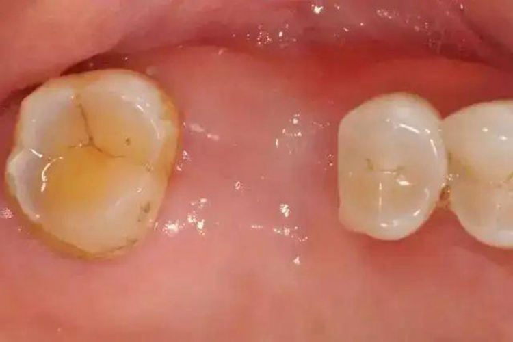 牙槽窝完全愈合图