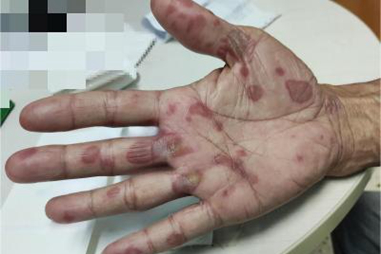 重型多形红斑手掌靶形红斑图