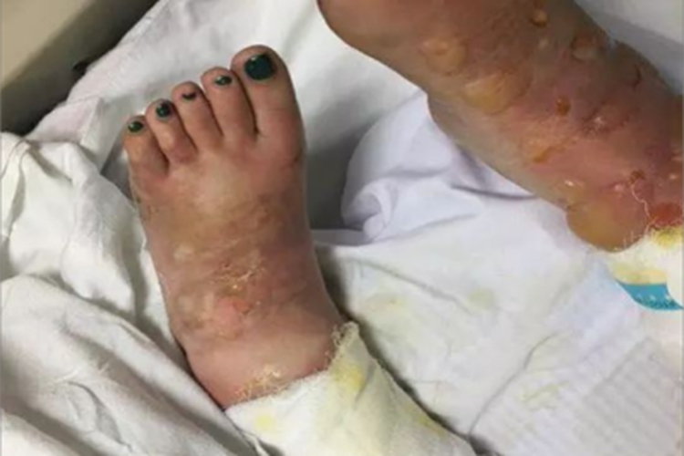 浅Ⅱ度烧伤脚背水疱图 浅Ⅱ度烧伤脚背水疱图