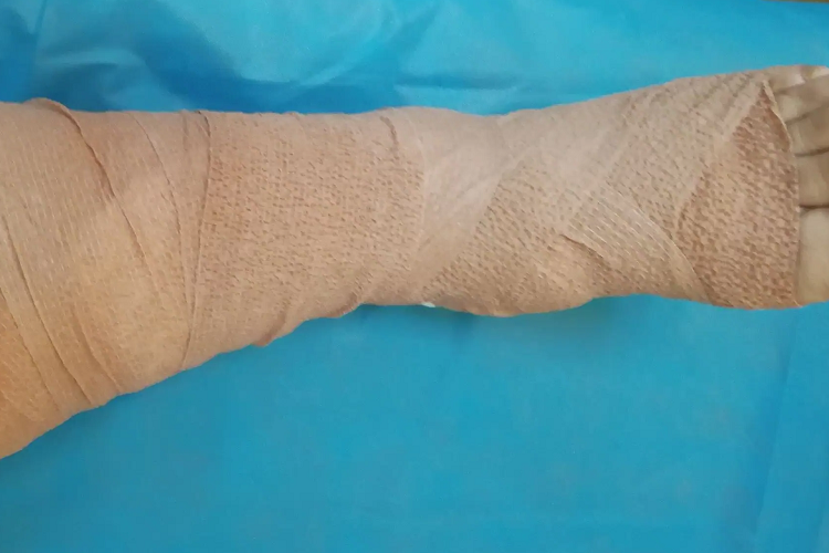 弹力绷带缠肢图 弹力绷带缠肢图