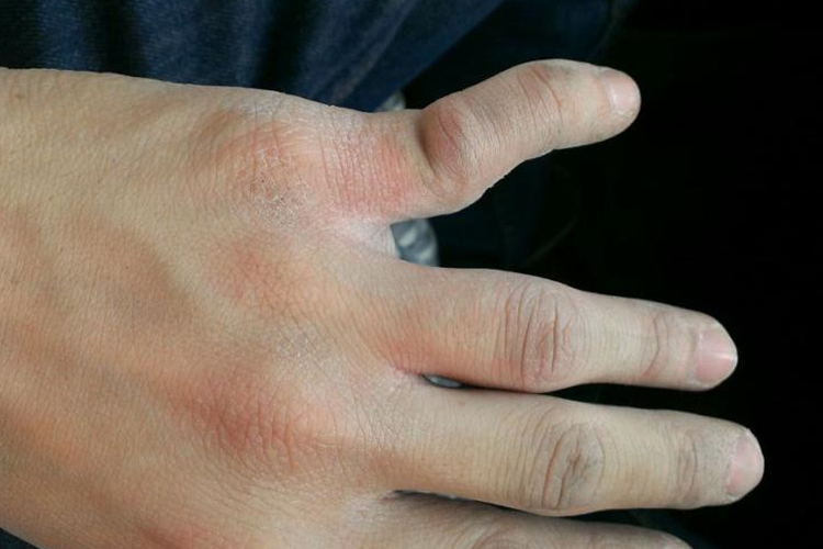 骨折手指轻微错位图