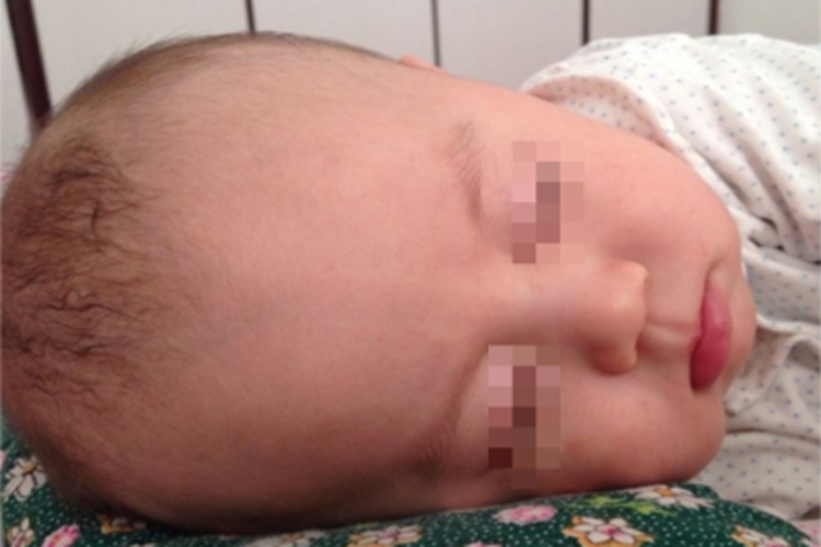 维生素D缺乏性佝偻病症状图 维生素D缺乏性佝偻病症状图