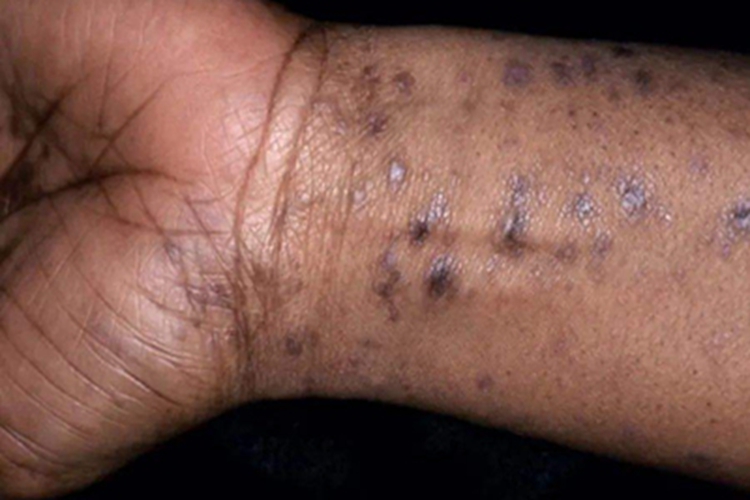 扁平苔藓手腕黑斑图