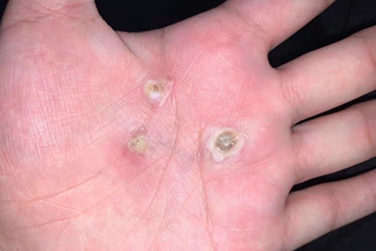 寻常疣手掌硬块图 寻常疣手掌硬块图