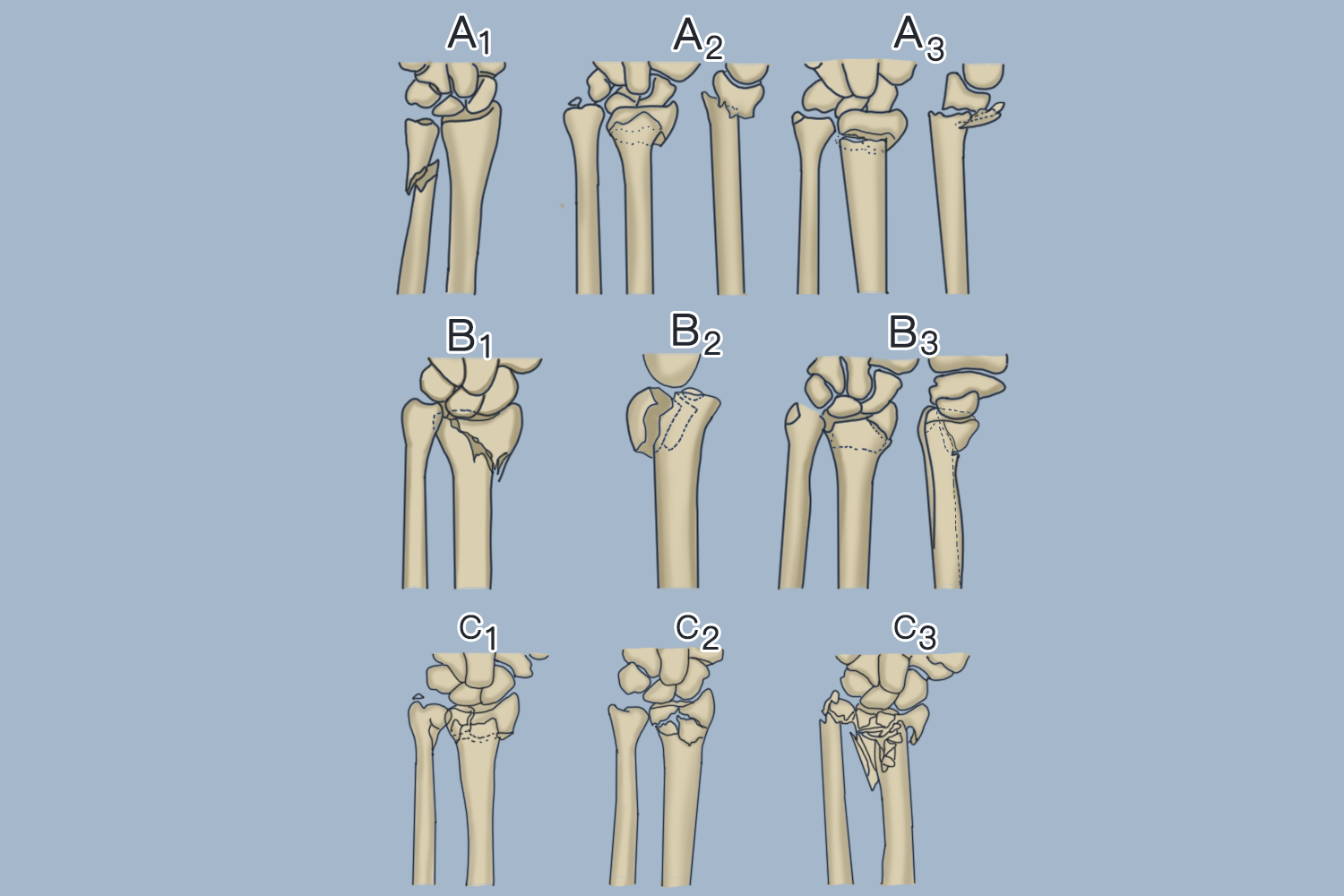 桡骨远端骨折AO分型图 桡骨远端骨折AO分型图