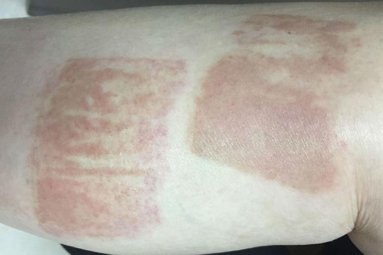 急性接触性皮炎小腿皮肤发红图 急性接触性皮炎小腿皮肤发红图