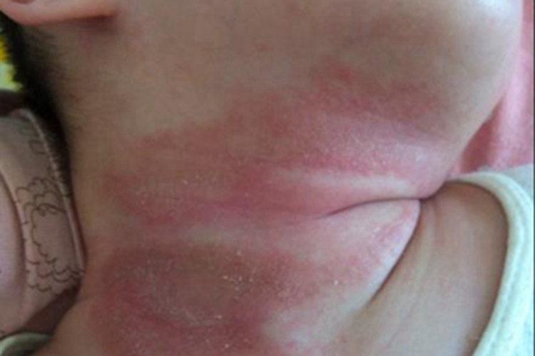 干燥型婴儿湿疹颈部脱屑图